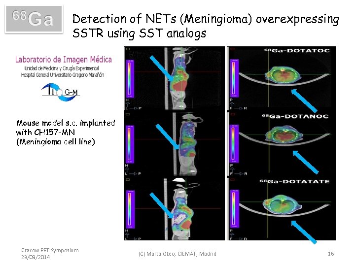 Detection of NETs (Meningioma) overexpressing SSTR using SST analogs Mouse model s. c. implanted