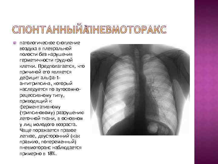  патологическое скопление воздуха в плевральной полости без нарушения герметичности грудной клетки. Предполагается, что