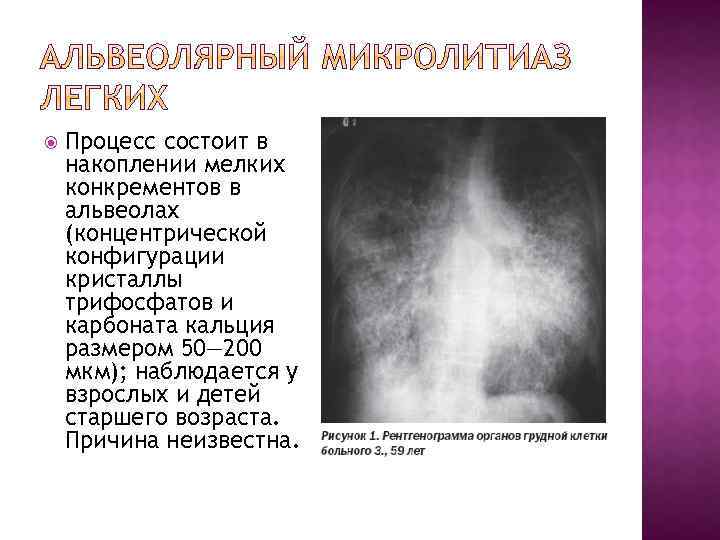  Процесс состоит в накоплении мелких конкрементов в альвеолах (концентрической конфигурации кристаллы трифосфатов и