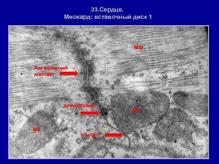 33. Сердце. Миокард: вставочный диск 1 • Мф Адгезивный контакт десмосома Мх нексус Мх