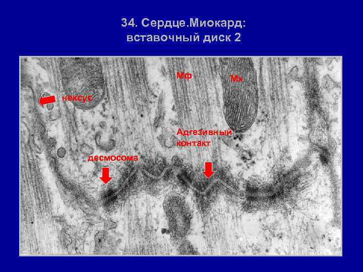 34. Сердце. Миокард: вставочный диск 2 • Мф Мх нексус Адгезивный контакт десмосома 