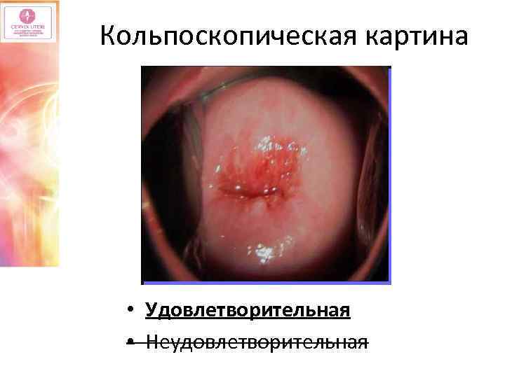 Кольпоскопическая картина • Удовлетворительная • Неудовлетворительная 