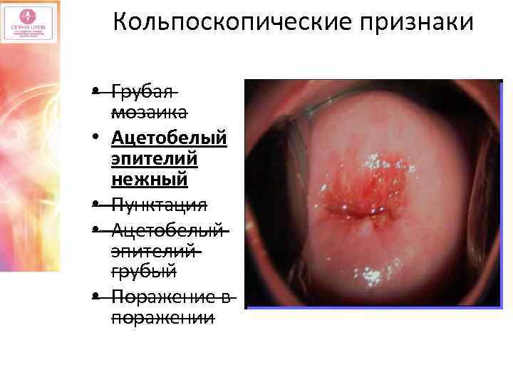 Кольпоскопические признаки • Грубая мозаика • Ацетобелый эпителий нежный • Пунктация • Ацетобелый эпителий