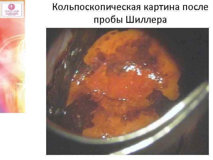 Кольпоскопическая картина после пробы Шиллера 