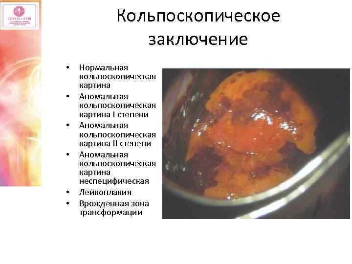 Кольпоскопическое заключение • • • Нормальная кольпоскопическая картина Аномальная кольпоскопическая картина I степени Аномальная