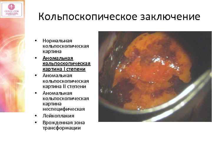 Кольпоскопическое заключение • • • Нормальная кольпоскопическая картина Аномальная кольпоскопическая картина I степени Аномальная