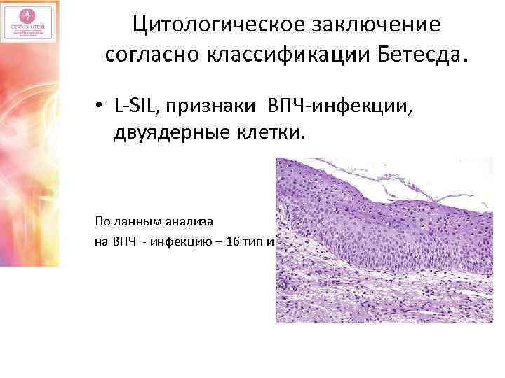 Двуядерные клетки в цитологии. Заключение по классификации Бетесда. Как образуются двуядерные клетки.