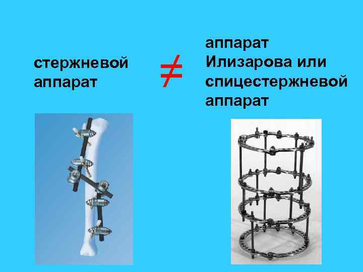 Аппарат илизарова презентация