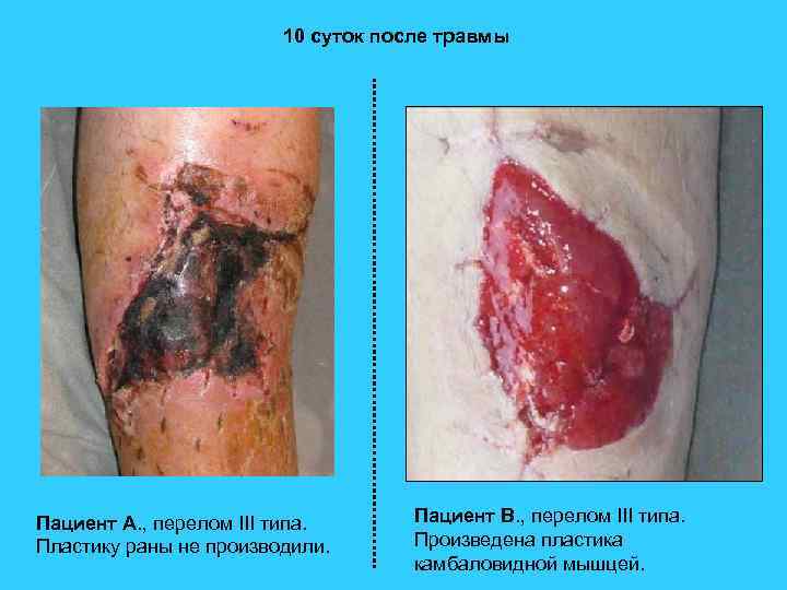 10 суток после травмы Пациент А. , перелом III типа. Пластику раны не производили.