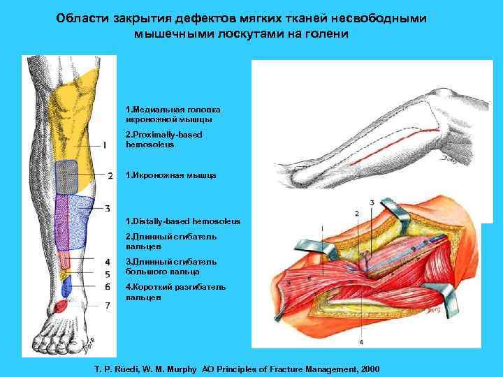 Области закрытия дефектов мягких тканей несвободными мышечными лоскутами на голени 1. Медиальная головка икроножной