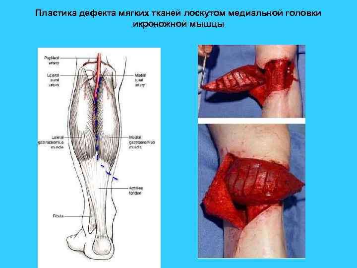 Пластика дефекта мягких тканей лоскутом медиальной головки икроножной мышцы 