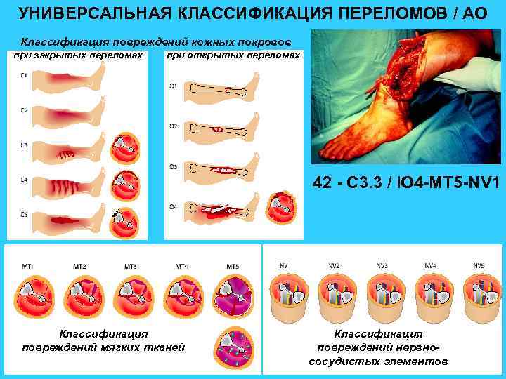 УНИВЕРСАЛЬНАЯ КЛАССИФИКАЦИЯ ПЕРЕЛОМОВ / АО Классификация повреждений кожных покровов при закрытых переломах при открытых