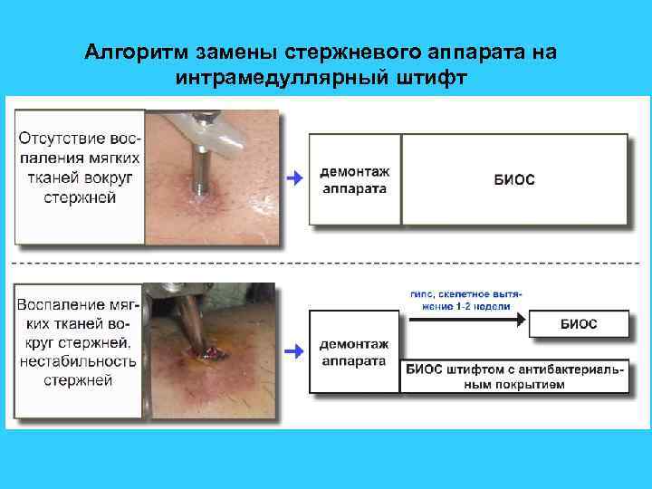 Алгоритм замены стержневого аппарата на интрамедуллярный штифт 