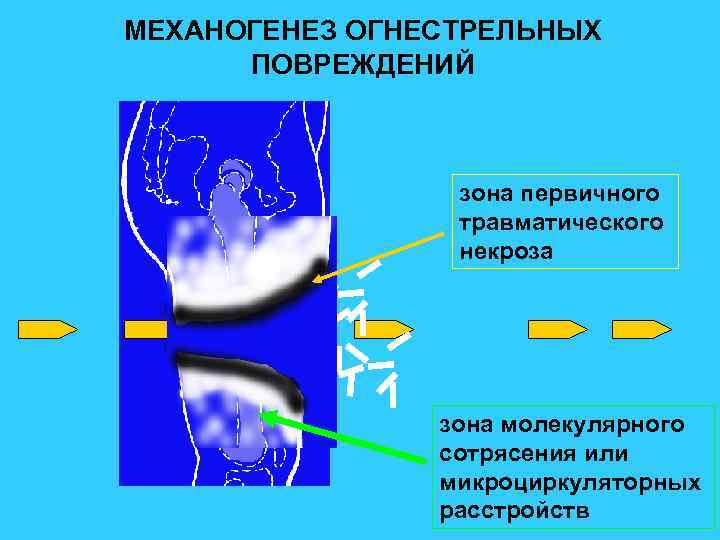 МЕХАНОГЕНЕЗ ОГНЕСТРЕЛЬНЫХ ПОВРЕЖДЕНИЙ зона первичного травматического некроза зона молекулярного сотрясения или микроциркуляторных расстройств 