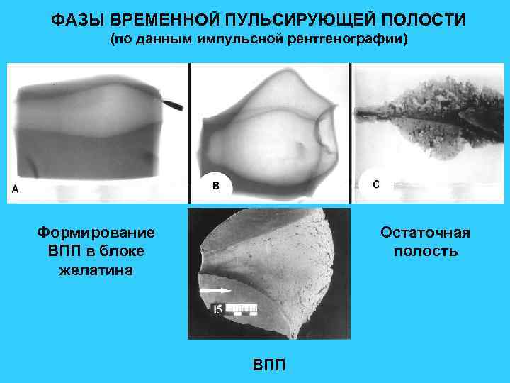 ФАЗЫ ВРЕМЕННОЙ ПУЛЬСИРУЮЩЕЙ ПОЛОСТИ (по данным импульсной рентгенографии) Формирование ВПП в блоке желатина Остаточная