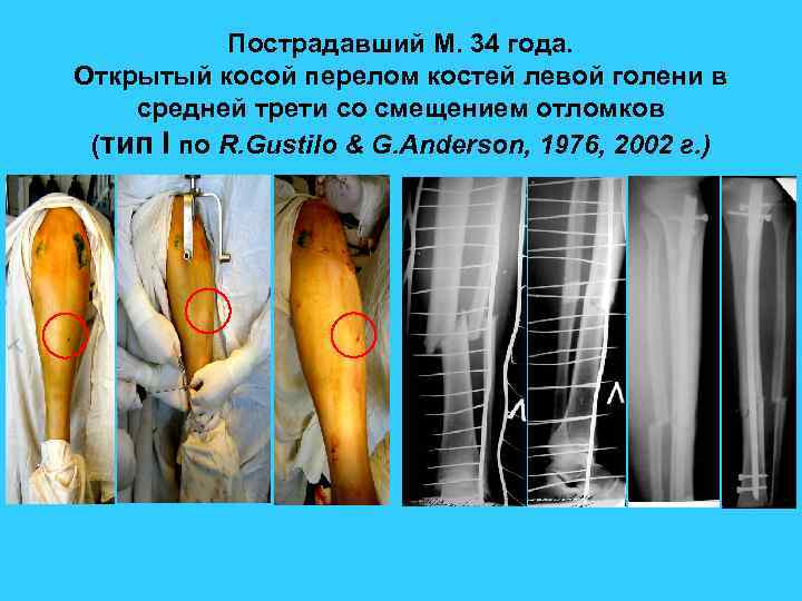 Пострадавший М. 34 года. Открытый косой перелом костей левой голени в средней трети со