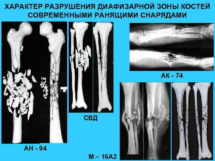 ХАРАКТЕР РАЗРУШЕНИЯ ДИАФИЗАРНОЙ ЗОНЫ КОСТЕЙ СОВРЕМЕННЫМИ РАНЯЩИМИ СНАРЯДАМИ АК - 74 СВД АН -