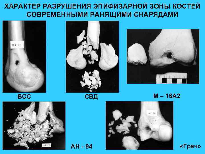 ХАРАКТЕР РАЗРУШЕНИЯ ЭПИФИЗАРНОЙ ЗОНЫ КОСТЕЙ СОВРЕМЕННЫМИ РАНЯЩИМИ СНАРЯДАМИ ВСС СВД АН - 94 М