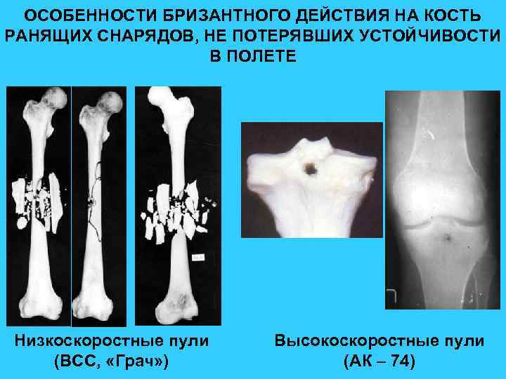 ОСОБЕННОСТИ БРИЗАНТНОГО ДЕЙСТВИЯ НА КОСТЬ РАНЯЩИХ СНАРЯДОВ, НЕ ПОТЕРЯВШИХ УСТОЙЧИВОСТИ В ПОЛЕТЕ Низкоскоростные пули