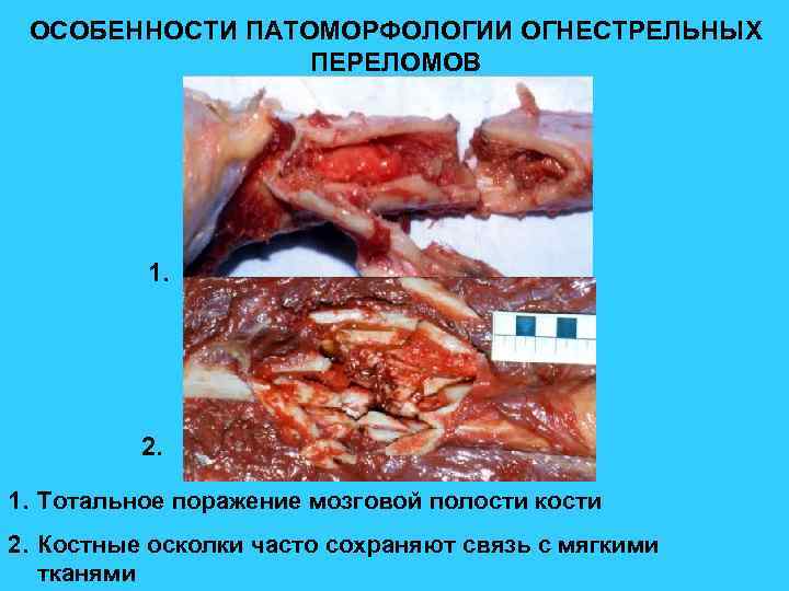 ОСОБЕННОСТИ ПАТОМОРФОЛОГИИ ОГНЕСТРЕЛЬНЫХ ПЕРЕЛОМОВ 1. 2. 1. Тотальное поражение мозговой полости кости 2. Костные