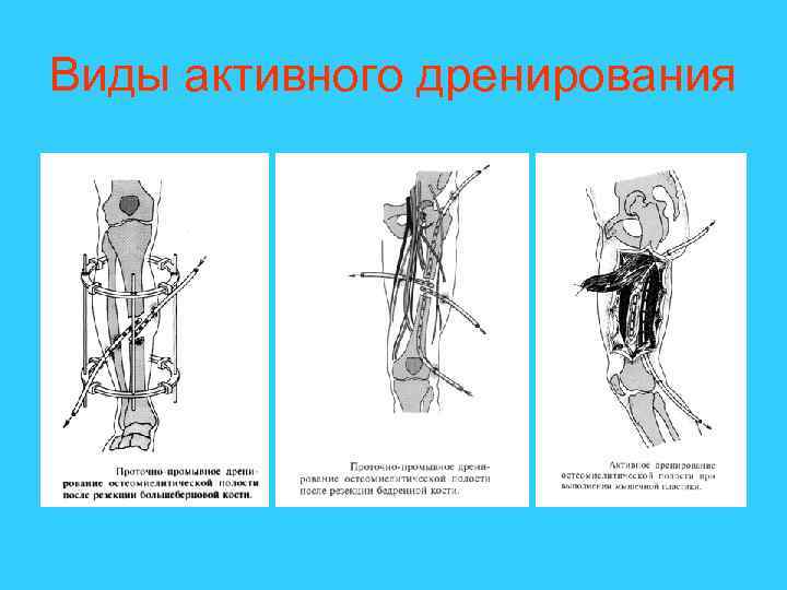 Виды активного дренирования 