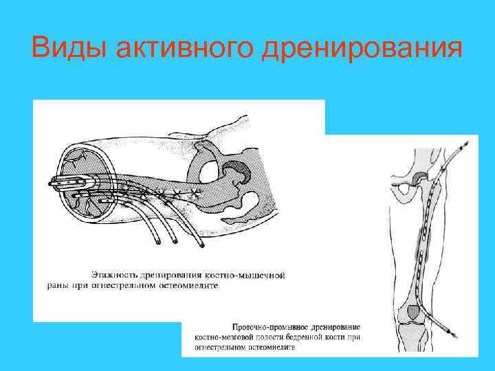 Виды активного дренирования 