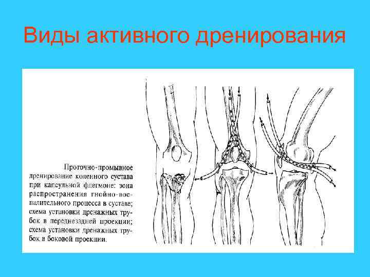 Виды активного дренирования 