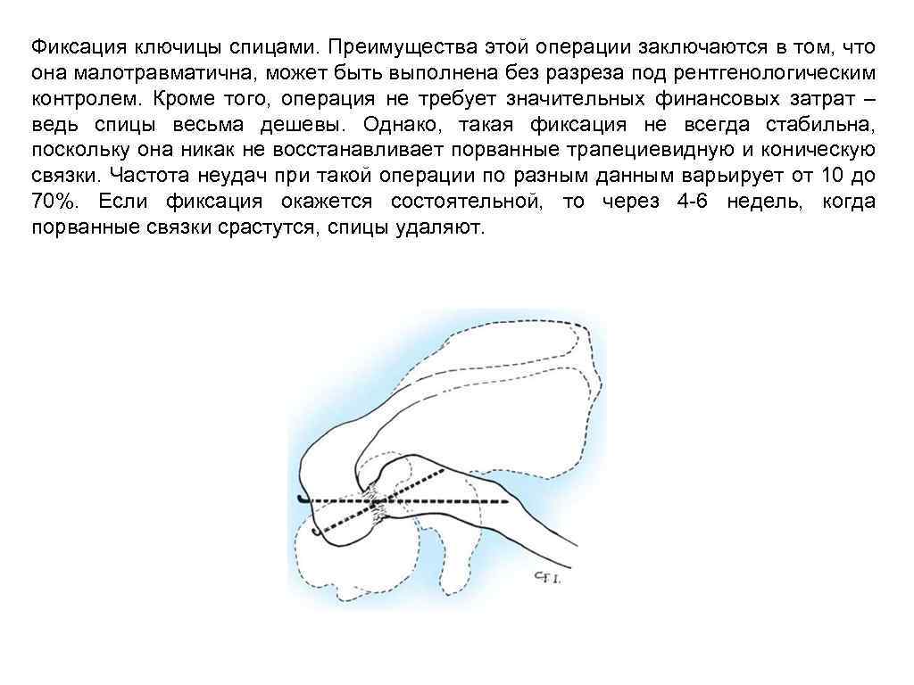 Операция ключица спицами. Фиксация ключицы спицами. Вывих плеча карта вызова скорой медицинской помощи шпаргалка. Вывих акромиального конца ключицы. Вывихи верхних конечностей.