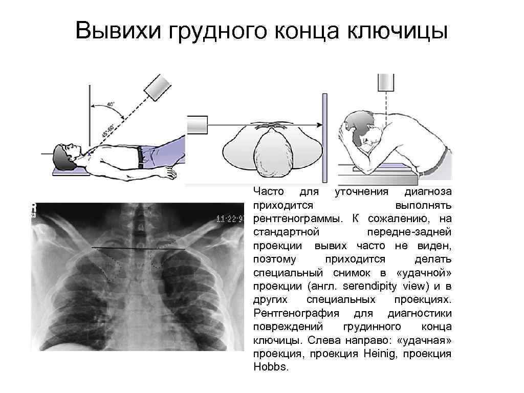 Как вправить ключицу. Подвывих грудинного конца ключицы рентген. Грудинный вывих ключицы симптомы. Вывих стернального конца ключицы рентген. Грудино-ключичное сочленение рентген укладка.