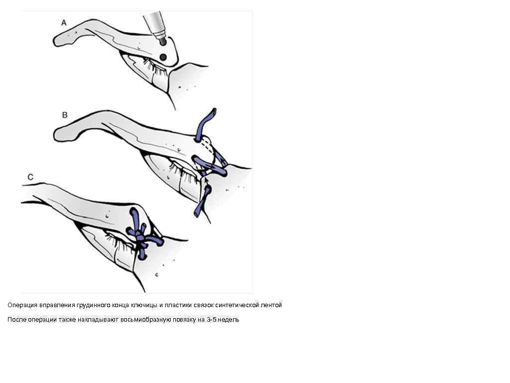Как вправить ключицу. Вывих стернального конца ключицы рентген. Операция при вывихе грудинного конца ключицы. Вывих грудинного конца ключицы рентген. Открытое вправление вывиха акромиального конца ключицы операция.