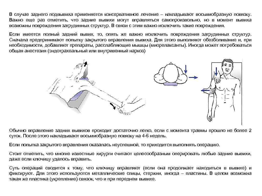 Как вправить ключицу