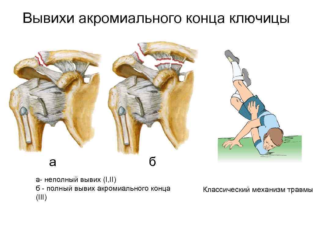 Вывих ключицы симптомы