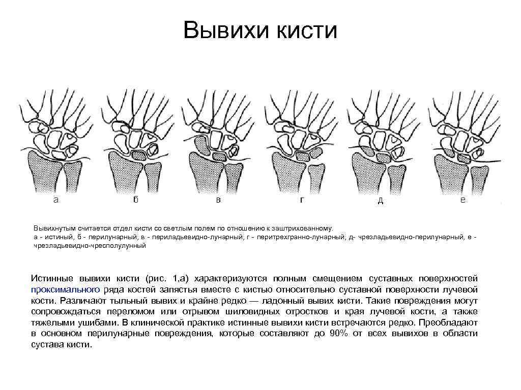 Растяжение связок кисти симптомы. Классификация вывихов костей кисти. Перилунарный вывих кисти. Вывихи костей запястья классификация. Вывих в лучезапястном суставе классификация.