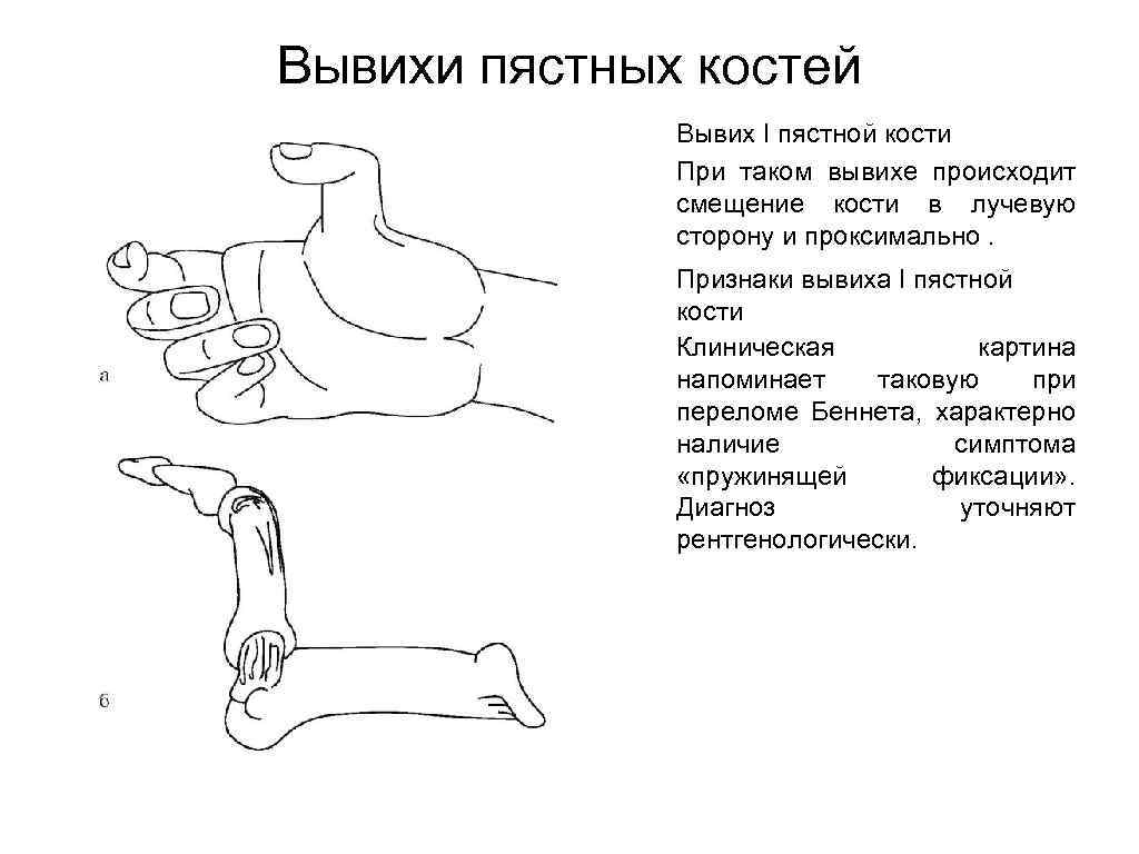 Признаками вывиха являются ответ