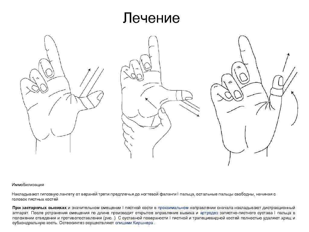 Вывих пальца кисти карта вызова