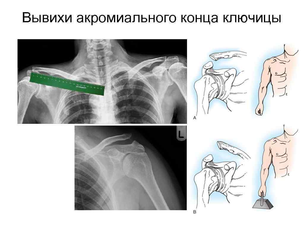 Вывих ключицы. Подвывих стернального конца ключицы. Загрудинный вывих ключицы. Полный вывих акромиального конца ключицы рентген. Неполный вывих ключицы рентген.