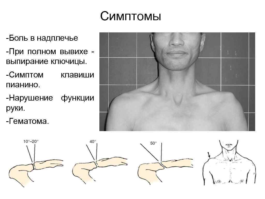 Как вправить ключицу. Характерным признаком вывиха акромиального конца ключицы. Подвывих акромиально-ключичного сочленения. Акромиальный вывих ключицы реабилитация. Симптомы вывиха акромиального конца ключицы.