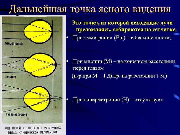 Дальнейшая точка ясного видения Это точка, из которой исходящие лучи преломляясь, собираются на сетчатке.