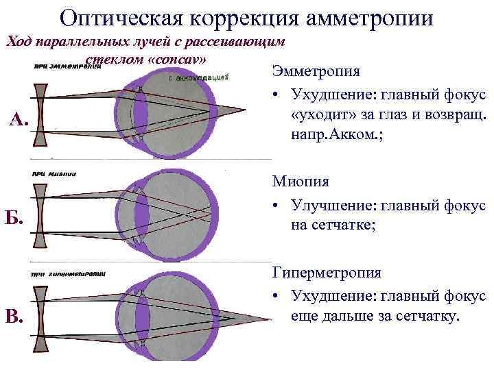 Оптическая коррекция амметропии Ход параллельных лучей с рассеивающим стеклом «concav» А. Эмметропия • Ухудшение: