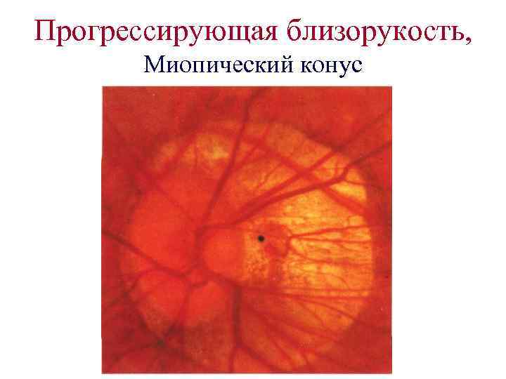 Прогрессирующая близорукость, Миопический конус 