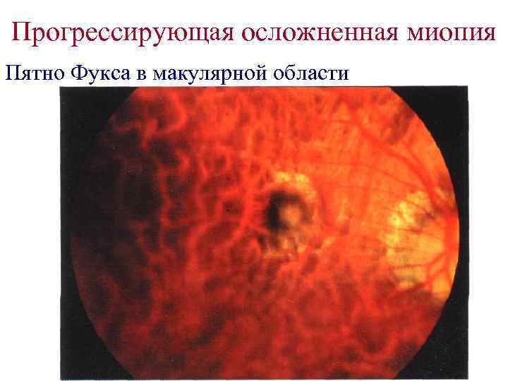 Прогрессирующая осложненная миопия Пятно Фукса в макулярной области 