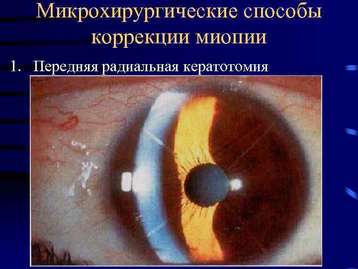 Микрохирургические способы коррекции миопии 1. Передняя радиальная кератотомия 