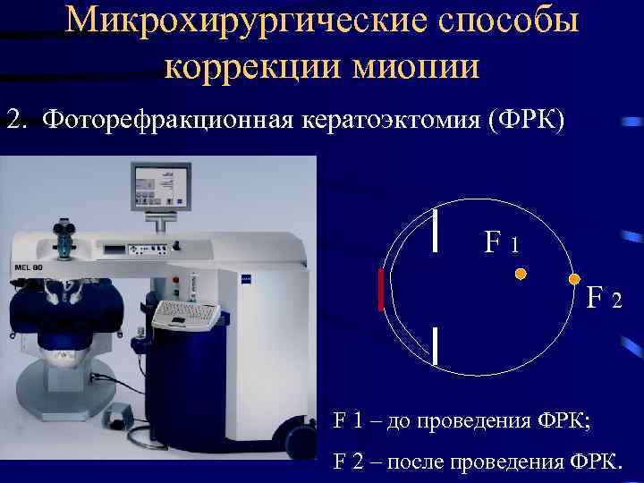 Микрохирургические способы коррекции миопии 2. Фоторефракционная кератоэктомия (ФРК) F 1 F 2 F 1