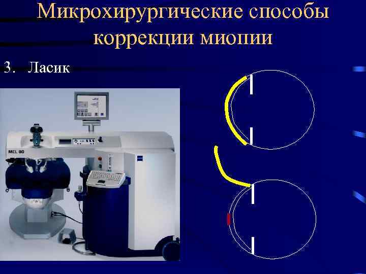 Микрохирургические способы коррекции миопии 3. Ласик 