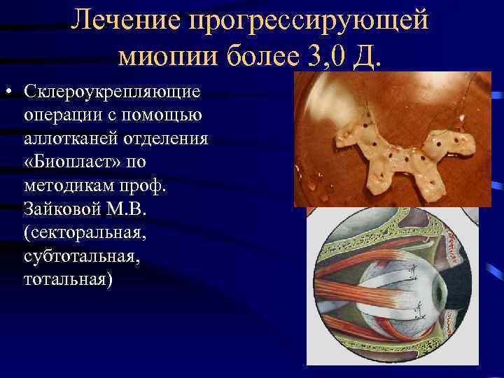 Лечение прогрессирующей миопии более 3, 0 Д. • Склероукрепляющие операции с помощью аллотканей отделения