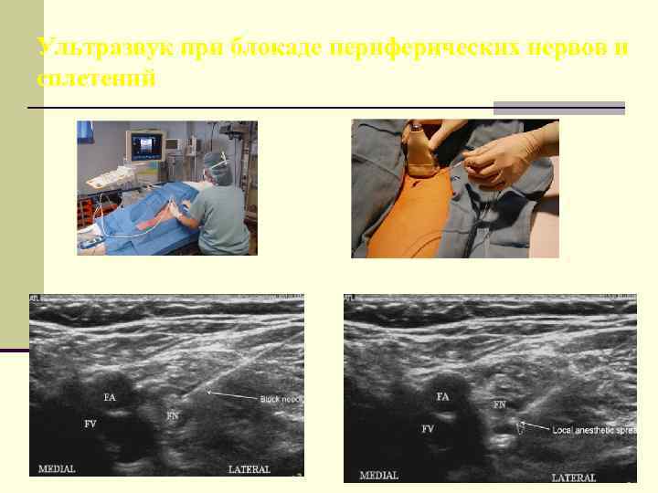 Ультразвук при блокаде периферических нервов и сплетений 