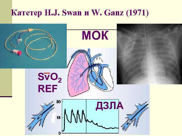 Катетер H. J. Swan и W. Ganz (1971) МОК Sv. O 2 REF ДЗЛА