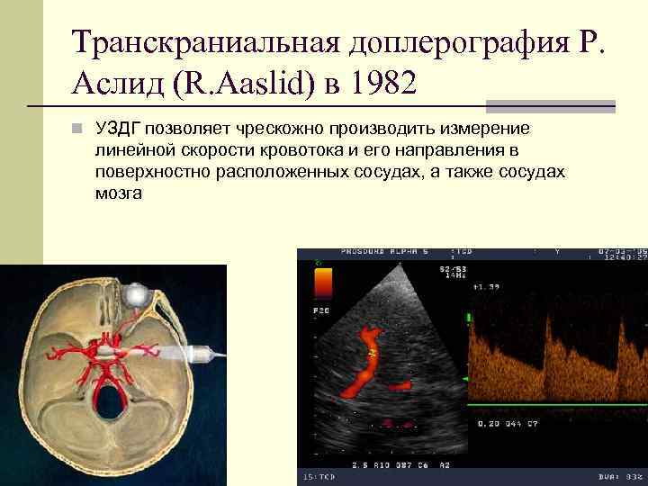 Транскраниальная доплерография Р. Аслид (R. Aaslid) в 1982 n УЗДГ позволяет чрескожно производить измерение