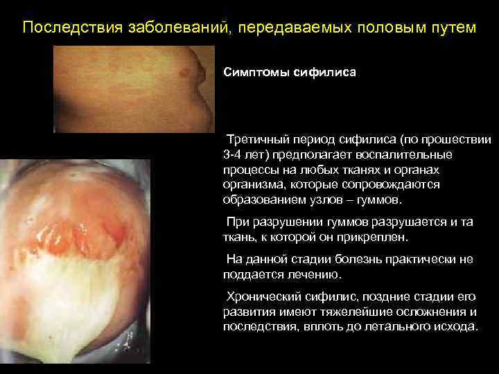 Последствия заболеваний, передаваемых половым путем Симптомы сифилиса Третичный период сифилиса (по прошествии 3 -4