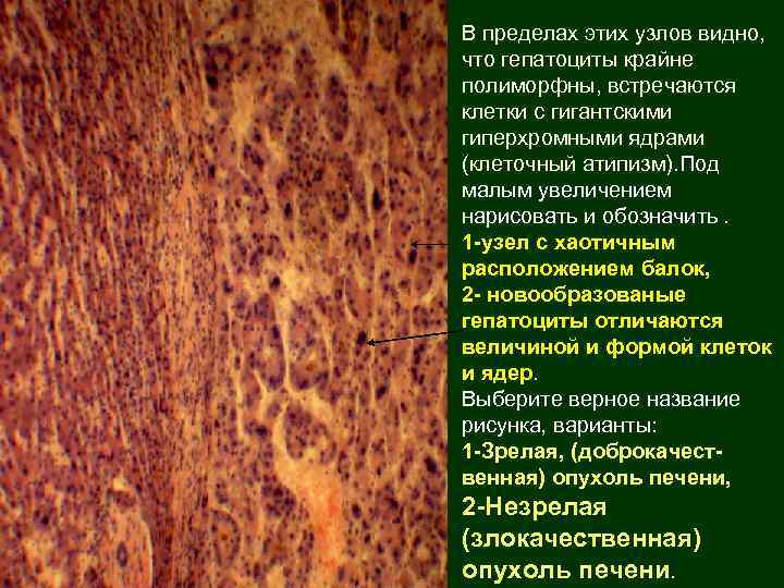 В пределах этих узлов видно, что гепатоциты крайне полиморфны, встречаются клетки с гигантскими гиперхромными